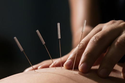 Acupuncture