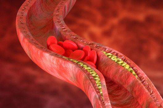 Atherosclerosis