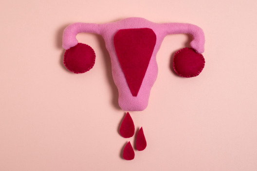 Menorrhagia