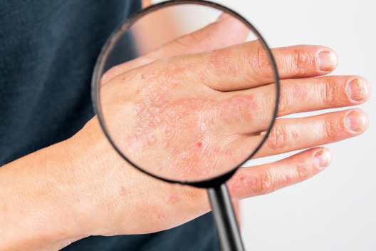 Eczema