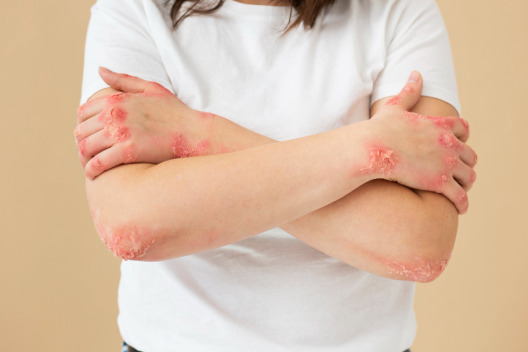 Psoriasis